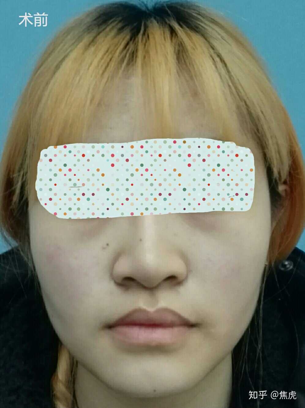 鼻孔大缩小多少钱(把鼻子变小的手术要多少钱)