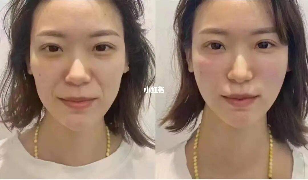 嗨体1.5去除法令纹费用的简单介绍