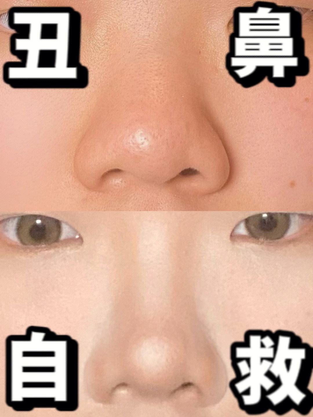 鼻子宽怎么缩小多少钱(鼻子宽大怎么变小,除了手术)