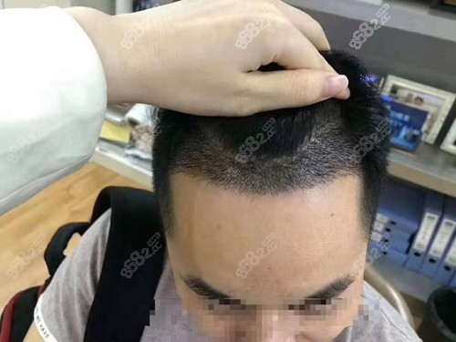 降低发际线费用(可以降低发际线吗)