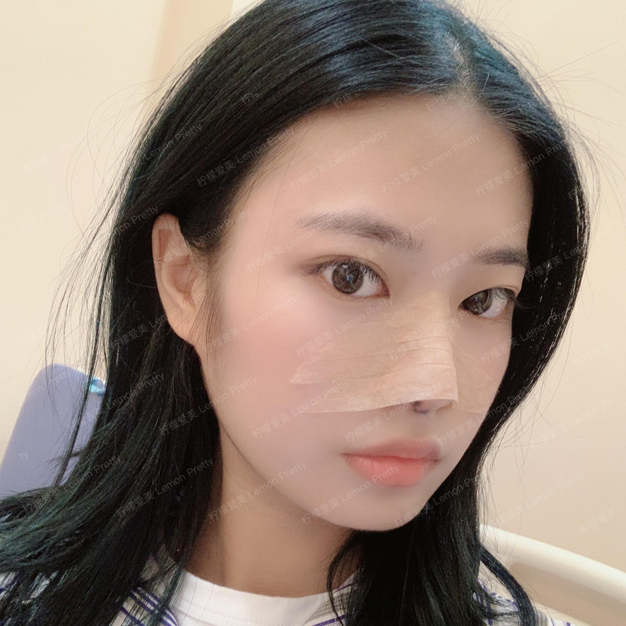 缩小鼻头要好多钱(单纯的缩小鼻头要多少钱)