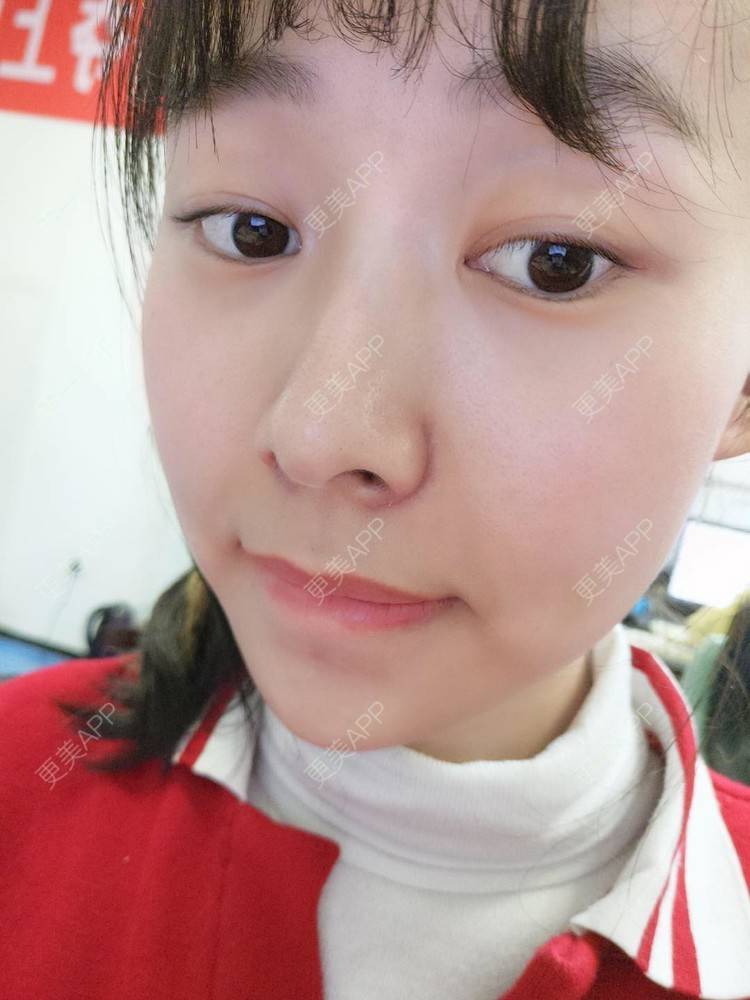大鼻子缩小多少钱(鼻子缩小多少钱视频)