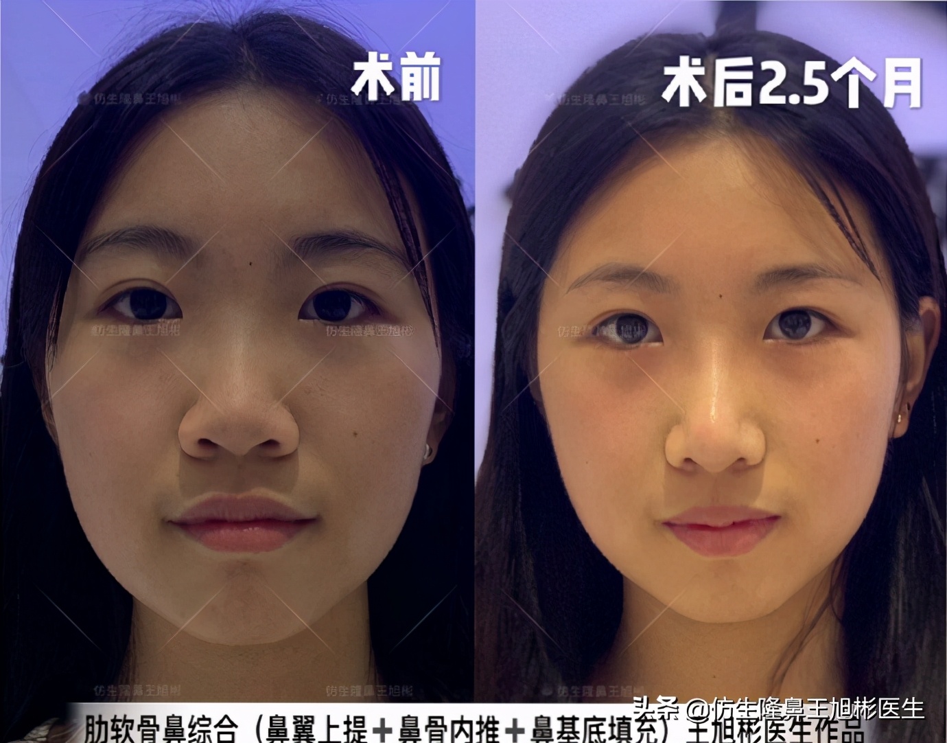 鼻缩小一共多少钱(做鼻子缩小手术有风险吗)