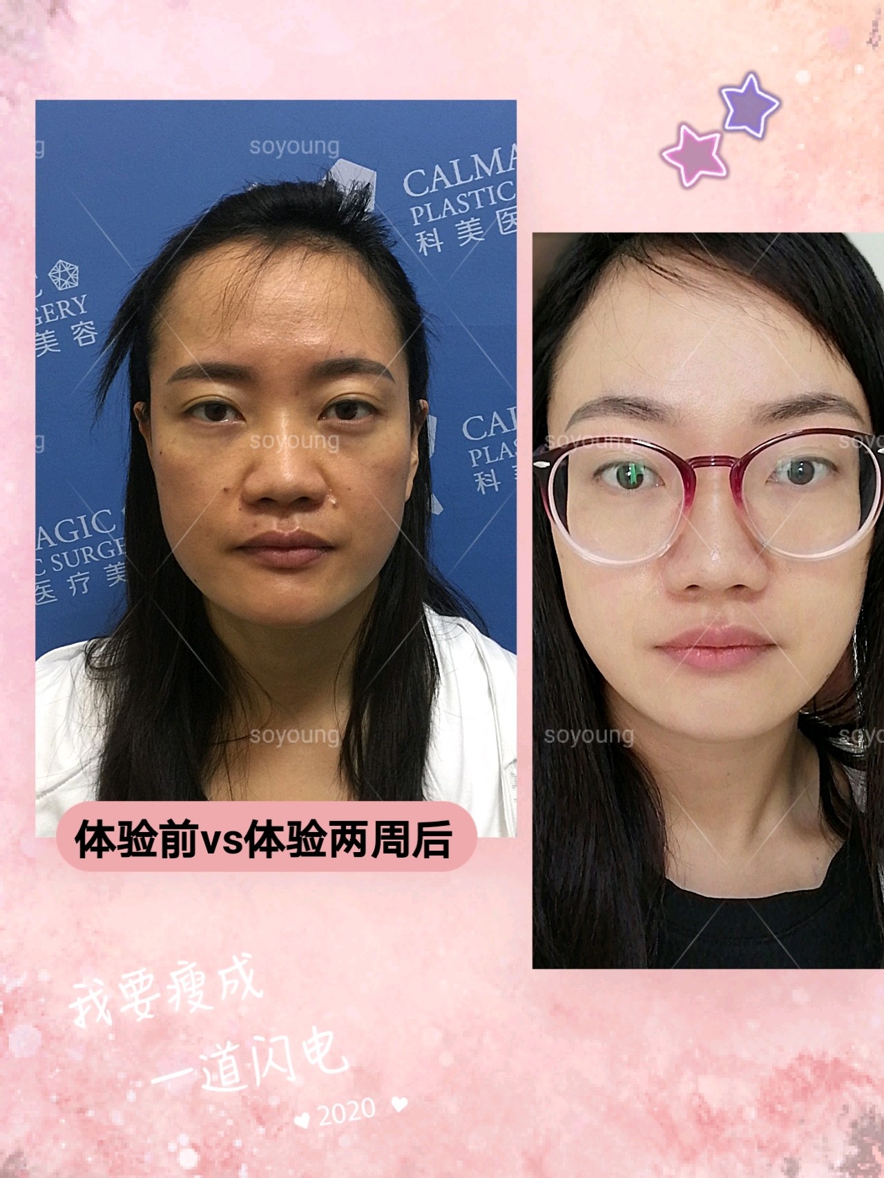 脸部提升对比形象图的简单介绍