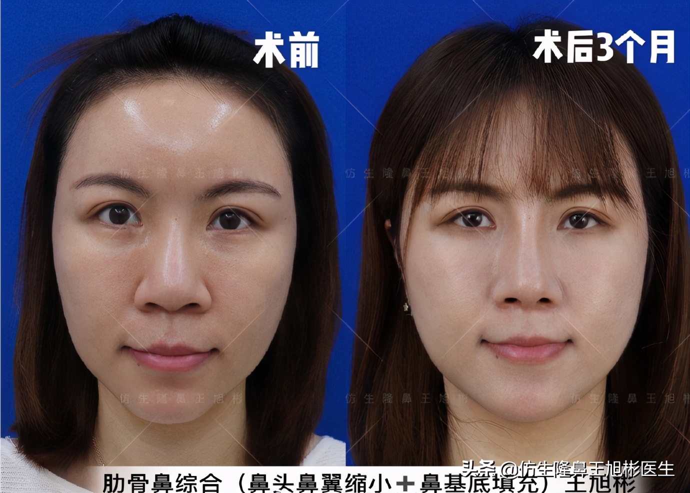 鼻缩小大约多少钱(鼻缩小手术多久痊愈)