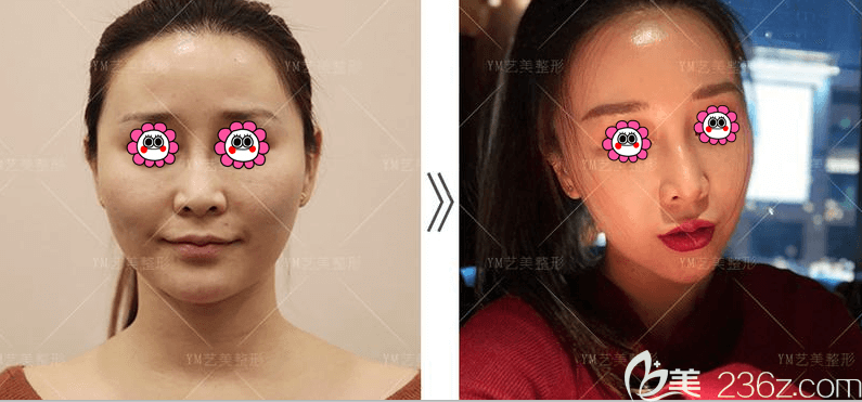 降颧骨手术多少钱(降低颧骨手术风险高吗)