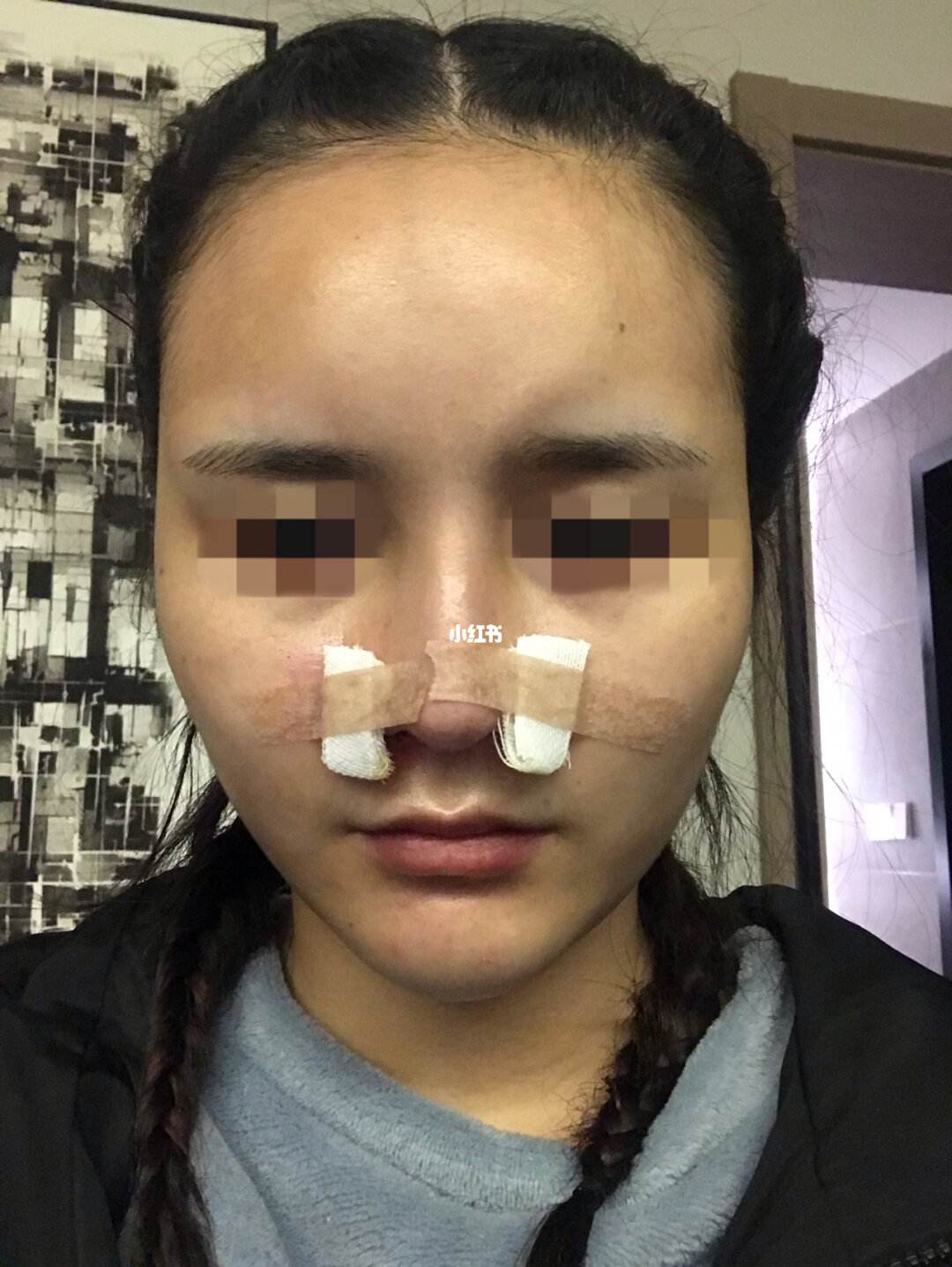 鼻翼太宽缩小的费用(鼻翼缩小一般需要多少钱选当代整形优)