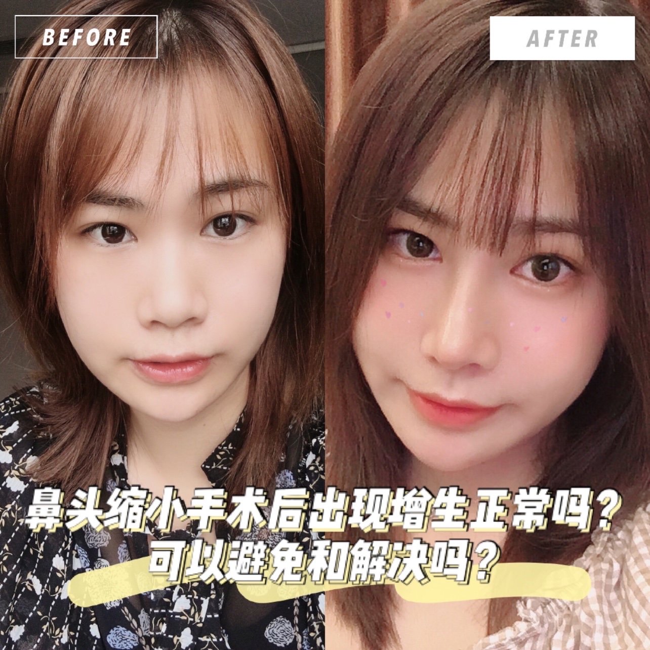 鼻子缩小大概多少钱(鼻子缩小大概多少钱一次)