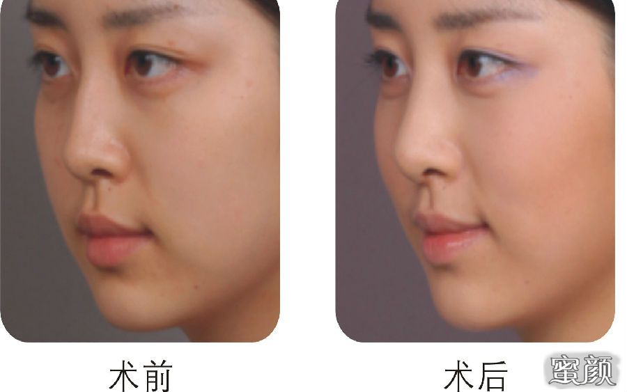鼻子缩小大概多少钱(鼻子缩小大概多少钱一次)