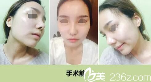缩小颧骨多少钱(3d颧骨缩小术原理)